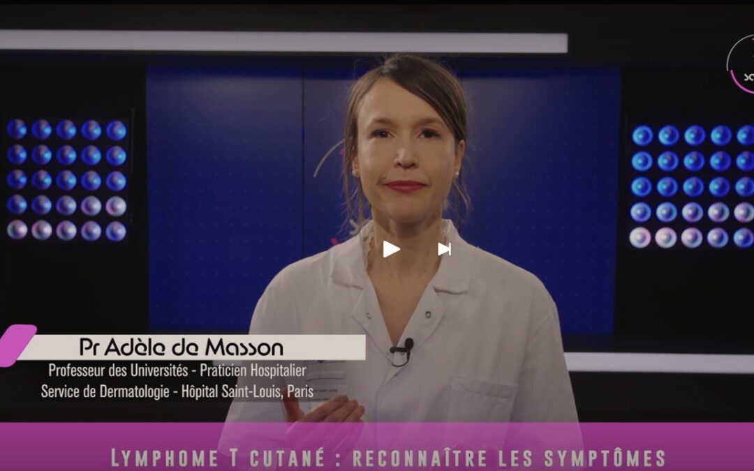 Recognizing the symptoms of cutaneous T-cell lymphoma